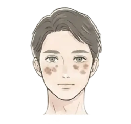 しみ・そばかす・肝斑 悩んでいる女性 画像