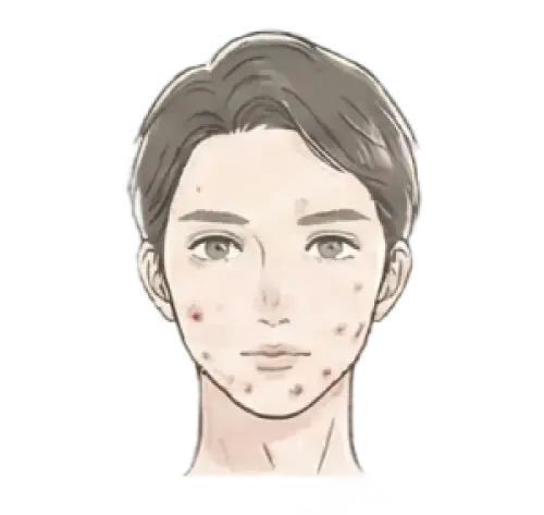 ニキビ・ニキビ跡 悩んでいる女性 画像